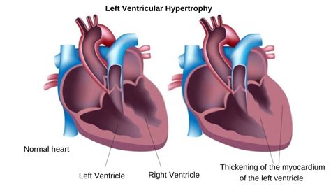 treatment for lv hypertrophy